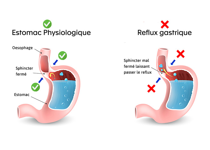 Le reflux gastrooesophagien PNF Thérapie